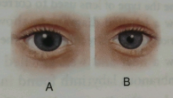 Que-1: The figures (A) and (B) given below are showing some kind of adjustment. Study the figures and answer the questions that follow.