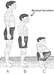 Que-5: Human height is mainly controlled by genetic factors but hormonal secretion is also equally important in regulating the height. Study the figures given below and answer the questions that follow :