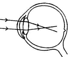 Question 2. Given below is a diagram depicting a defect of the human eye, study the same and then answer the questions that follow : 