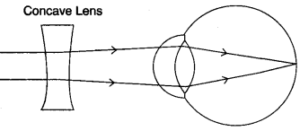 (iv) With the help of a diagram show how the defect shown above is rectified using a suitable lens.
